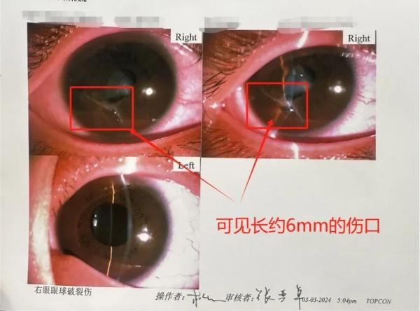 心疼!男孩被剪刀划破眼球,原来是为了帮几个月大的妹妹...... 心疼!男孩被剪刀划破眼球,原来是为了帮几个月大的妹妹......