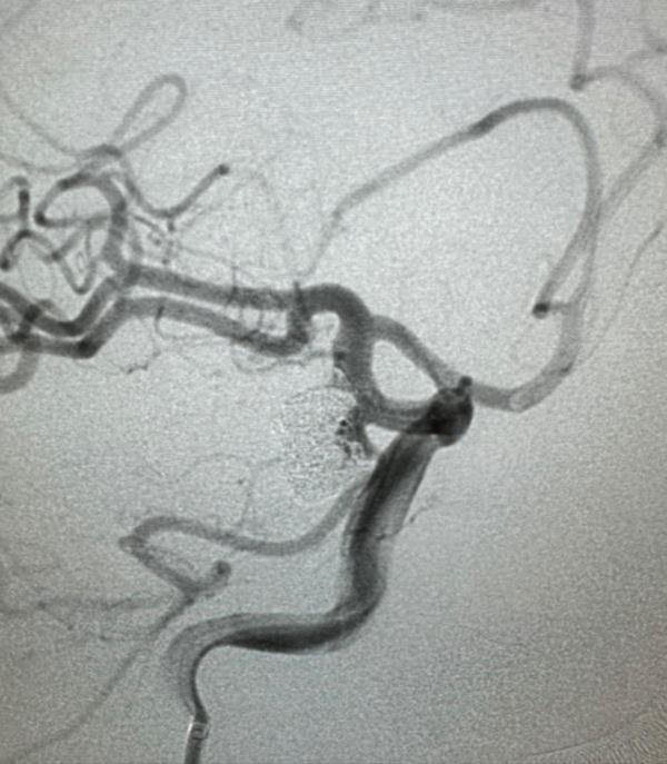 男子持续头痛,竟是脑内有“炸弹”! 男子持续头痛,竟是脑内有“炸弹”!