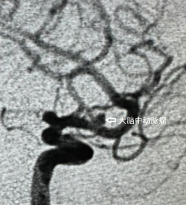 男子持续头痛,竟是脑内有“炸弹”! 男子持续头痛,竟是脑内有“炸弹”!