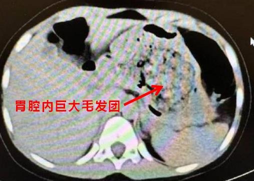 5岁女孩确诊“长发公主详细征”！医师领导：警惕这些特殊