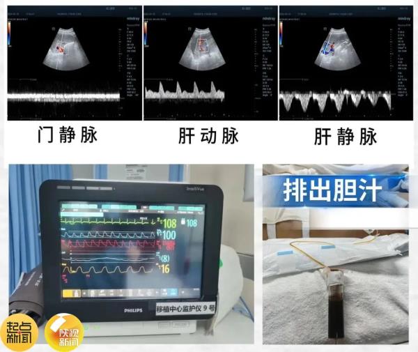 世界首例！西京医院成功实施→