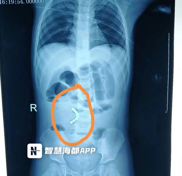 泉州一3岁幼童6处肠穿孔！医生取出……你家可能也有