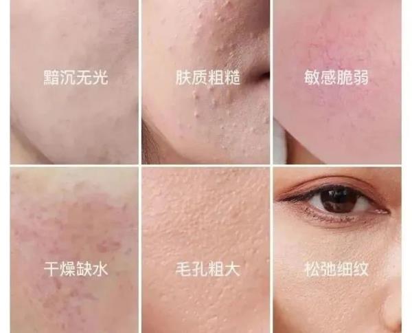 【春季护肤】护肤不当竟然烂脸......