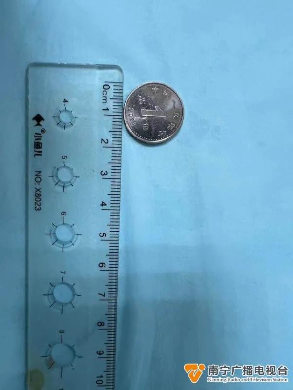 3岁宝宝误吞硬币，医生紧急处理！重要提醒→