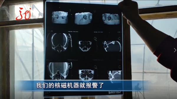 惊险！大庆一男子眼中取出藏了多年的“铁钉”！