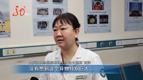 惊险！大庆一男子眼中取出藏了多年的“铁钉”！