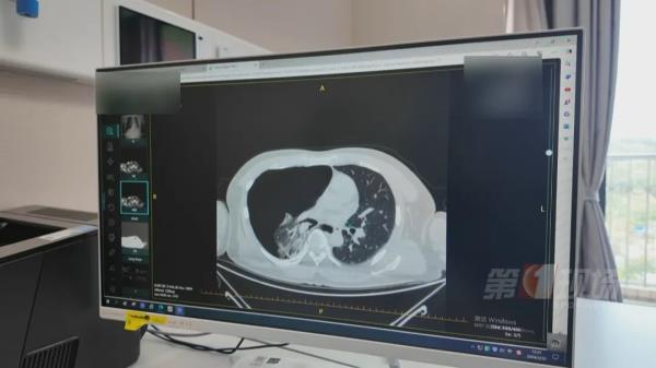 震惊！聊个天，肺突然就“炸”了……