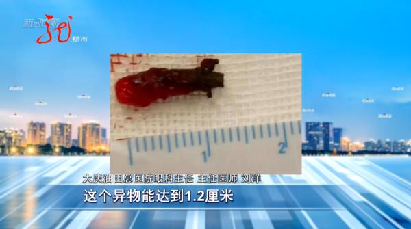 惊险！大庆一男子眼中取出藏了多年的“铁钉”！