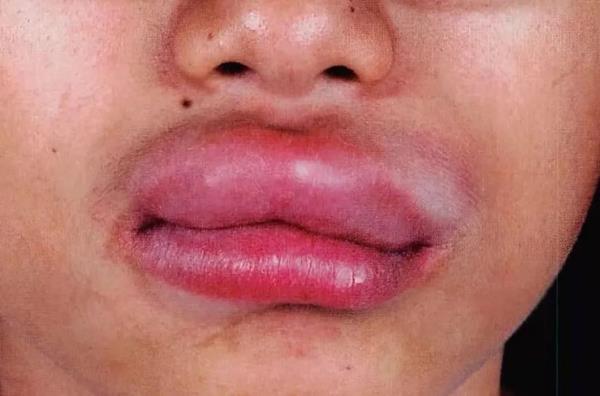 别笑！突发“香肠嘴”也可能危及生命