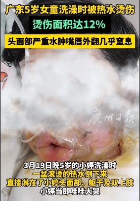 恐毁容!5岁女童突发意外,头部水肿、嘴唇外翻,危及生命! 恐毁容!5岁女童突发意外,头部水肿、嘴唇外翻,危及生命!