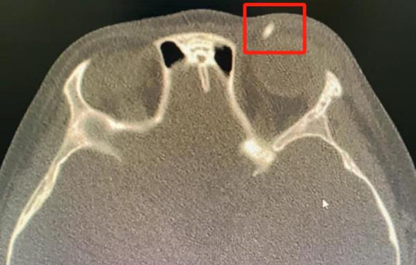 青岛一6岁男孩眼睑发炎化脓！医生竟夹出一截……家长千万注意！