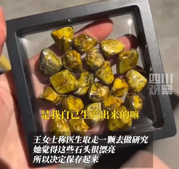 重庆一女子手术取出24颗胆结石没事盘着玩...... 重庆一女子手术取出24颗胆结石没事盘着玩......