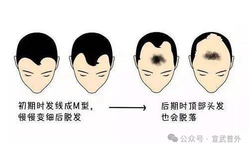 脂溢性脱发好发于青年男性,因此人们常称之为"早秃".