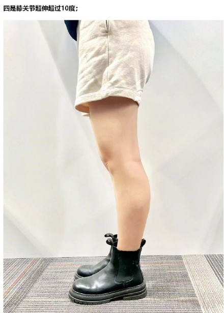 瑜伽做得太好或有多关节松弛症,五招自测↓↓ 瑜伽做得太好或有多关节松弛症,五招自测↓↓