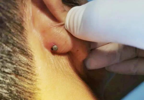 注意！这个“黑点”又来了，严重可致命