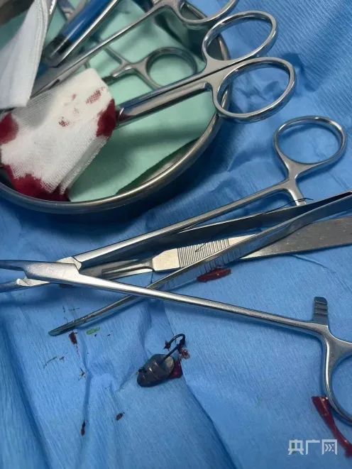 “好像有人掐我脖子”!女子河边遛弯遭“鱼钩封喉”?多方回应 “好像有人掐我脖子”!女子河边遛弯遭“鱼钩封喉”?多方回应