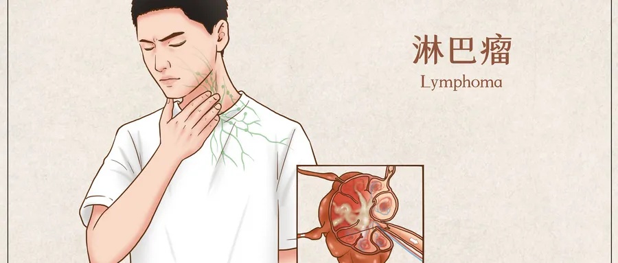 惊了！张嘴呼吸，浙江男子睡觉打呼竟查出血癌！医生：发展较快