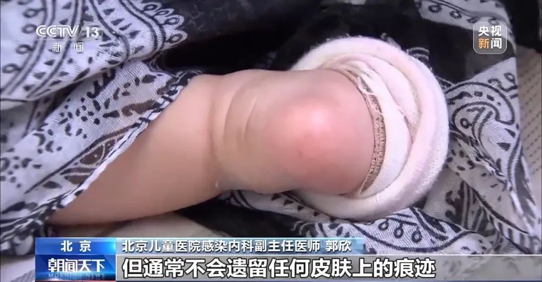 扩散丨春季多发，常见于2-5岁，严重时会影响生命！