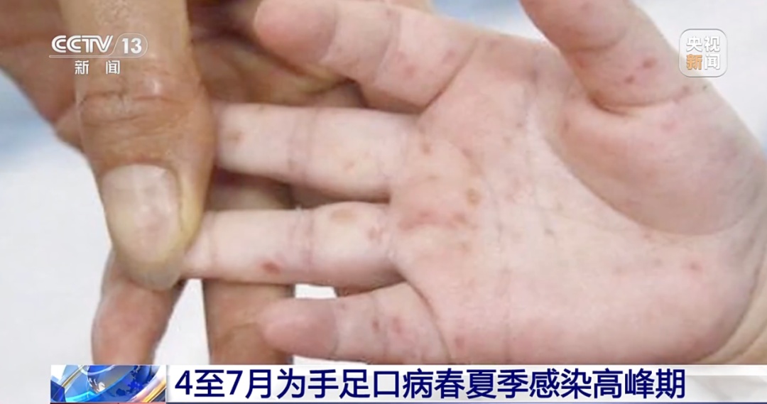 扩散丨春季多发，常见于2-5岁，严重时会影响生命！