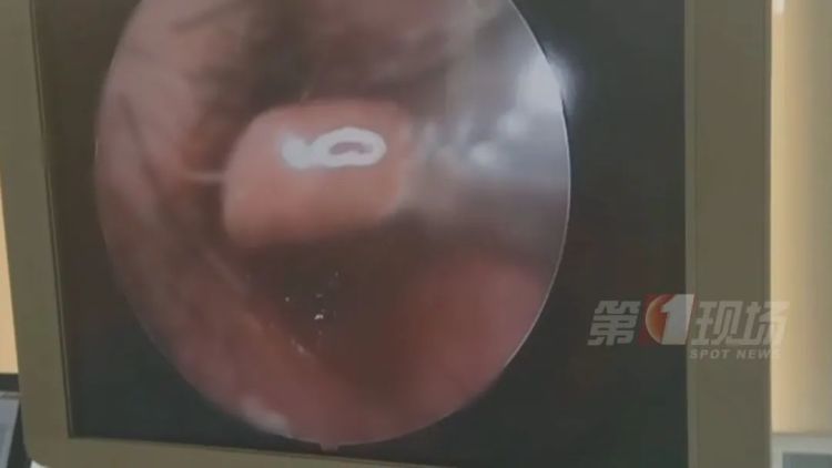 广东一男子鼻中，拽出7-8厘米水蛭！只因……很多人都做过