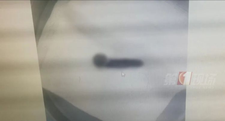 广东一男子鼻中，拽出7-8厘米水蛭！只因……很多人都做过