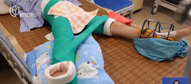 “没救了，神经都没有！”男孩多处骨折多脏器损伤 上海医生这样做