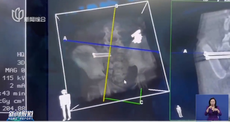 “没救了，神经都没有！”男孩多处骨折多脏器损伤 上海医生这样做