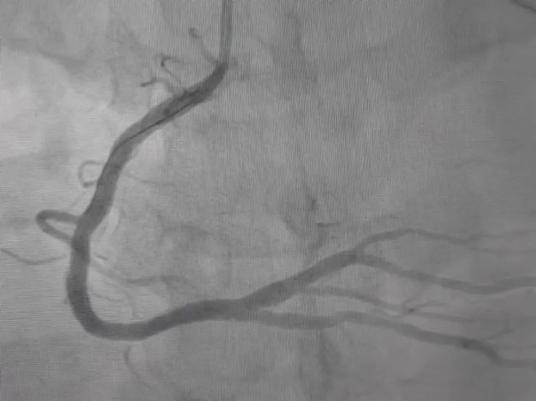 浙江90后小伙心肌梗死!这件事他连续干了5天!网友扎心:真的停不下来... 浙江90后小伙心肌梗死!这件事他连续干了5天!网友扎心:真的停不下来...