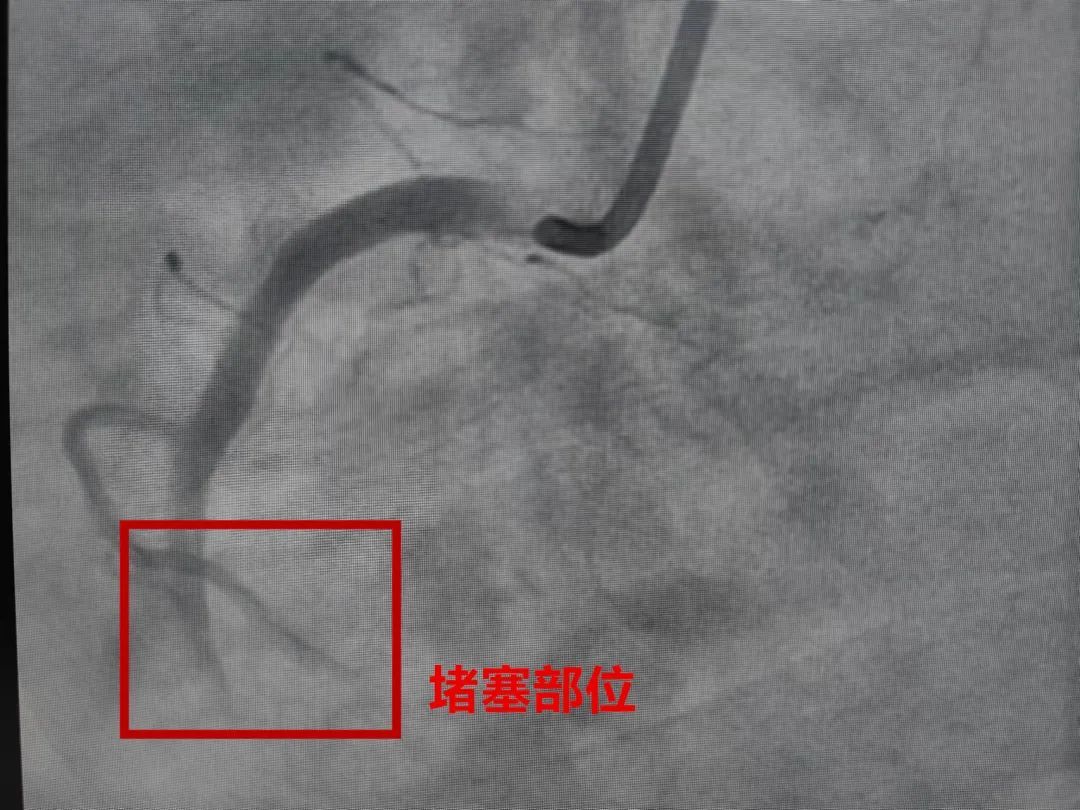 浙江90后小伙心肌梗死!这件事他连续干了5天!网友扎心:真的停不下来... 浙江90后小伙心肌梗死!这件事他连续干了5天!网友扎心:真的停不下来...