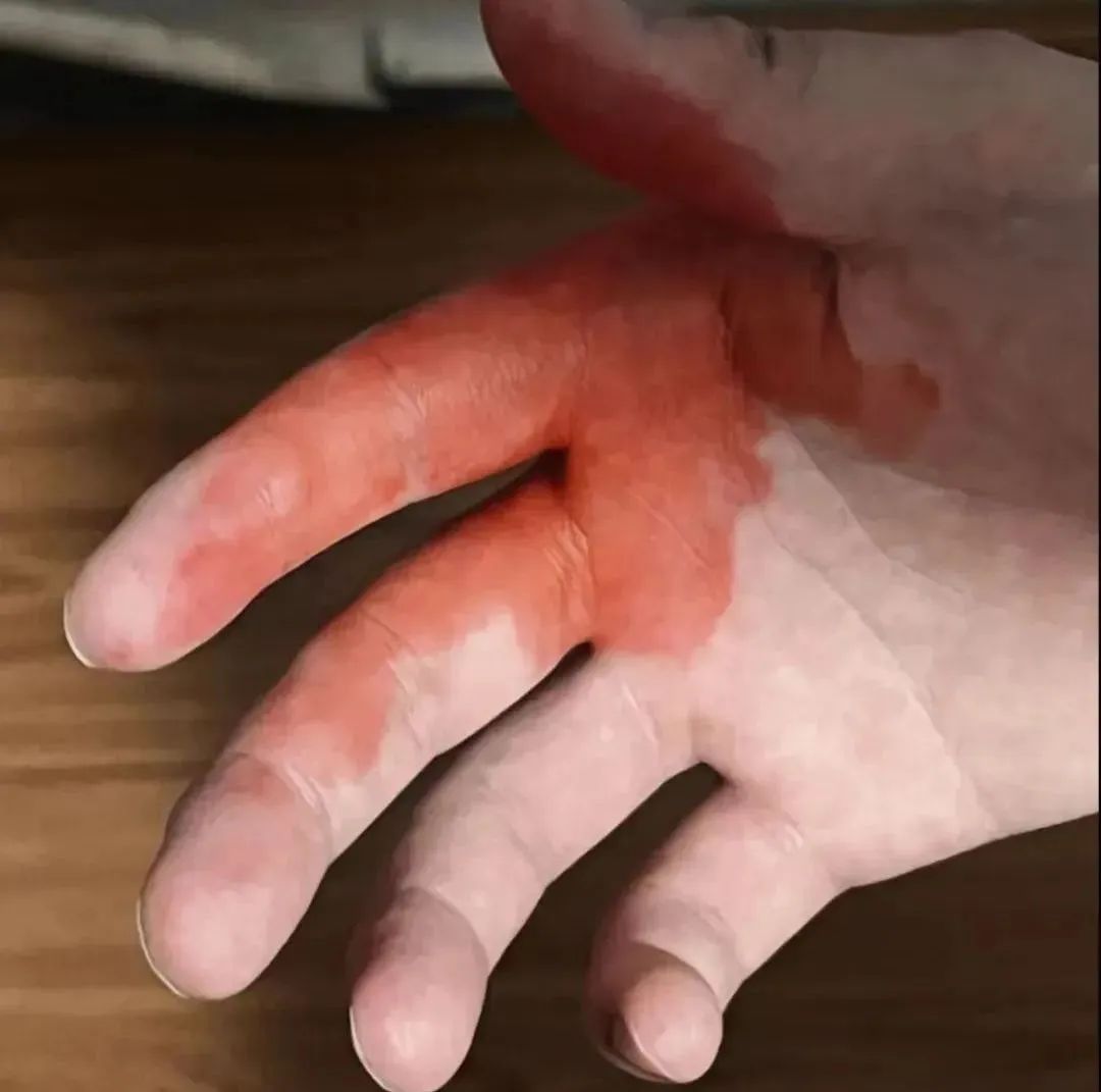 别再用了！你熟悉的这种“外伤神药”被淘汰了