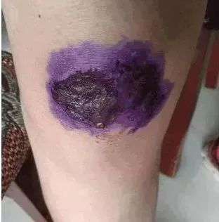 别再用了！你熟悉的这种“外伤神药”被淘汰了