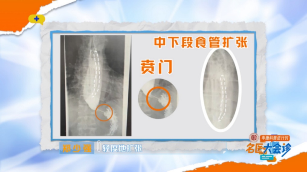 男子暴瘦！每次只能咽下一粒米？上海医生：这种病很痛苦