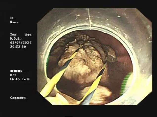 阜阳一老人胃里长出“大石头”！医生紧急提醒：千万别……