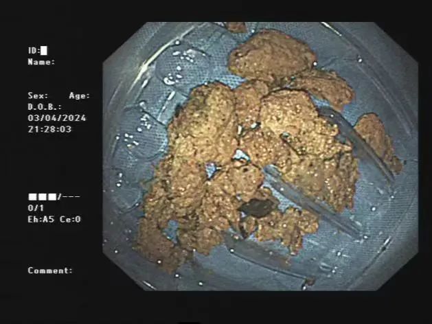 阜阳一老人胃里长出“大石头”！医生紧急提醒：千万别……