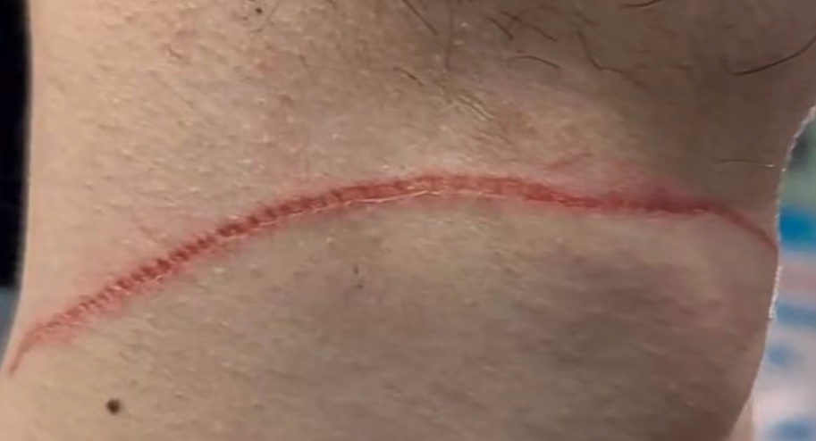 包头大学生骑车遭“割喉”险些窒息！这东西太危险，不止一次伤人