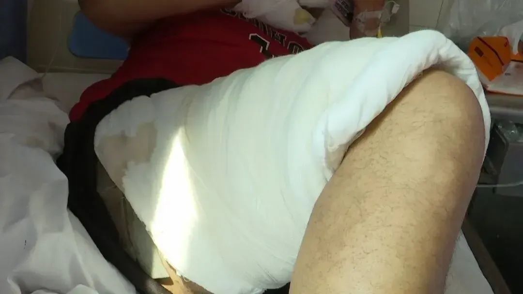 男子摔倒后,口袋里的手机突然爆炸!手脚被炸伤……医生紧急提醒 男子摔倒后,口袋里的手机突然爆炸!手脚被炸伤……医生紧急提醒