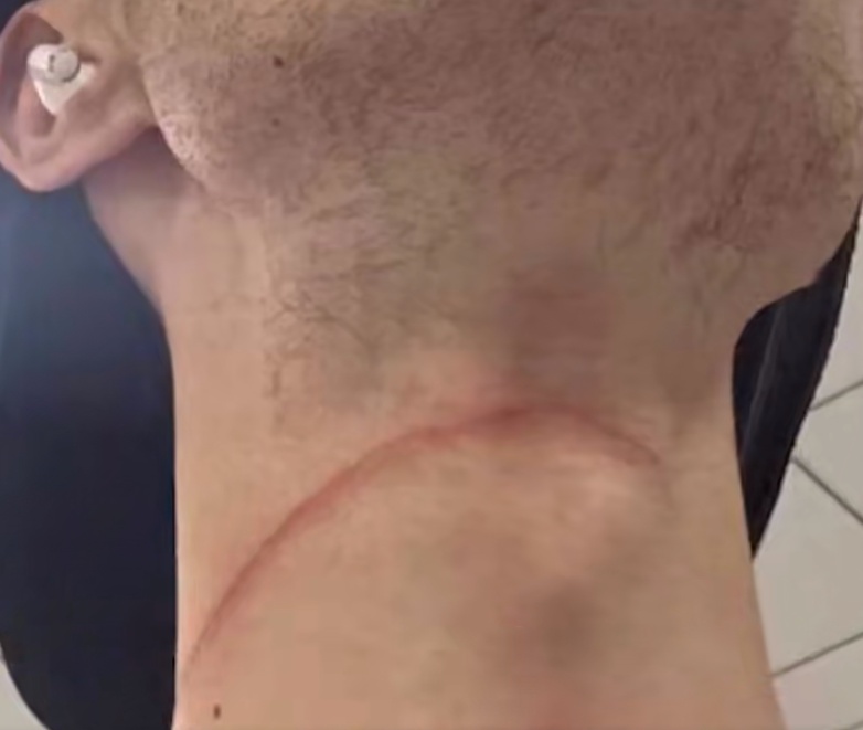 包头大学生骑车遭“割喉”险些窒息！这东西太危险，不止一次伤人