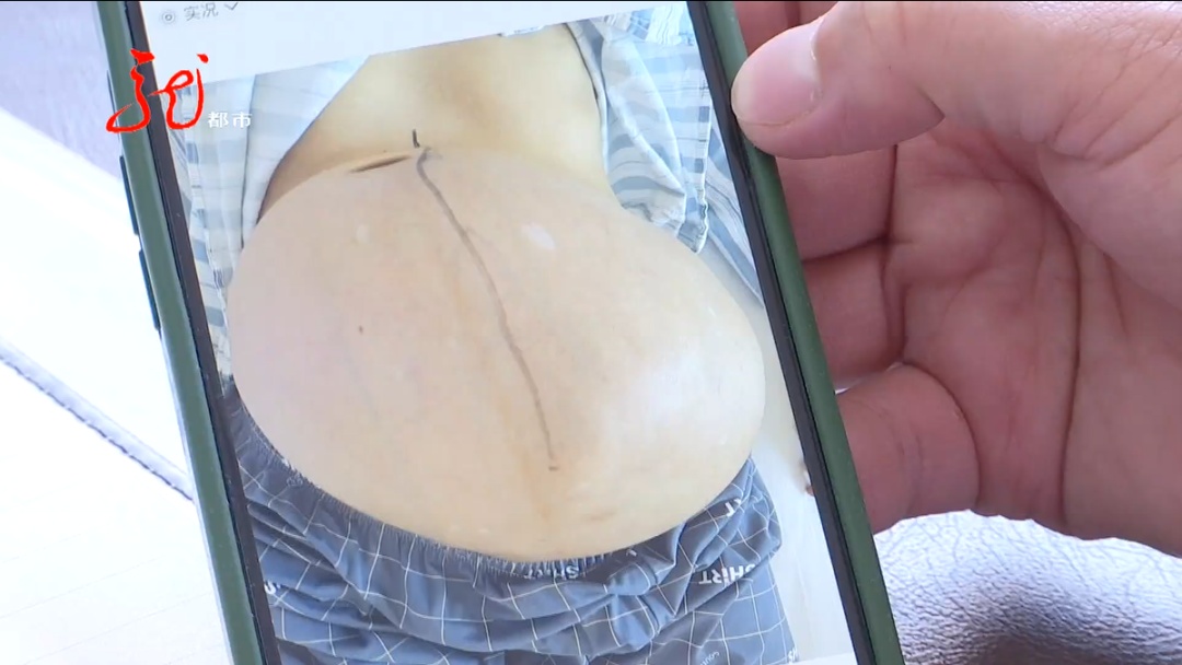 男子肚大像“怀孕”，竟是恶性肿瘤！