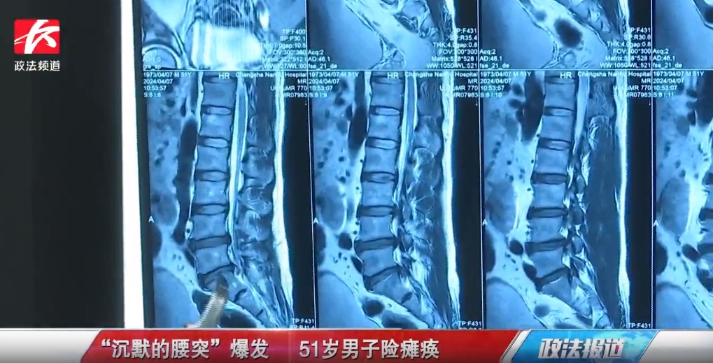 “沉默”的腰突爆发，51岁男子险瘫痪