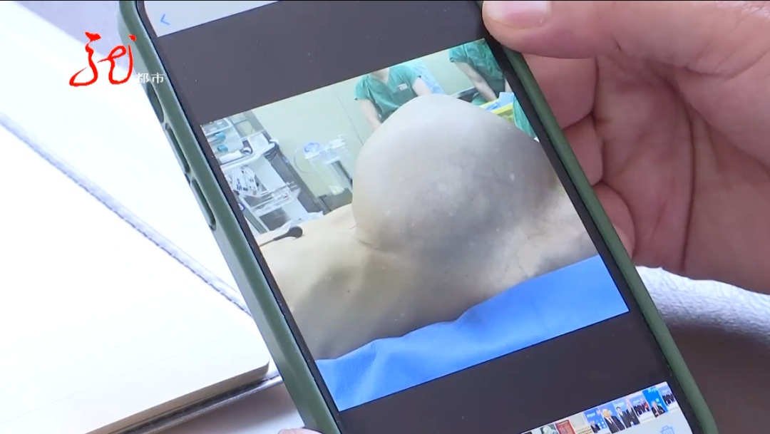 男子肚大像“怀孕”，竟是恶性肿瘤！