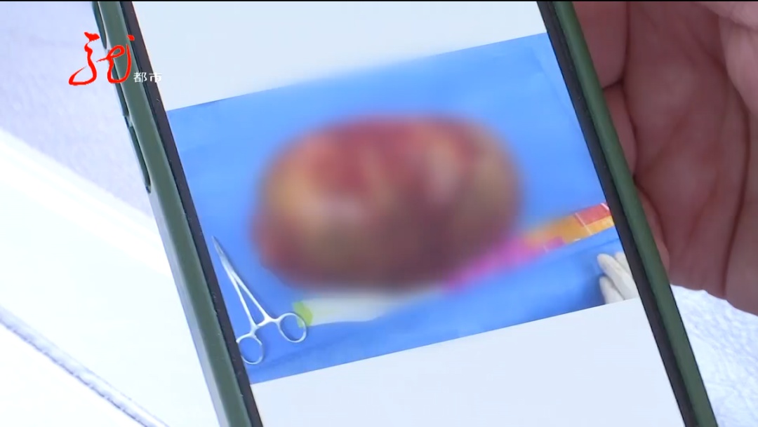 男子肚大像“怀孕”，竟是恶性肿瘤！