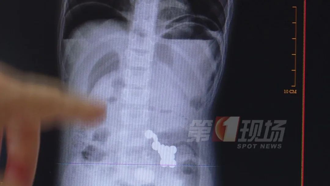 5岁娃吞了20多颗，消化道穿孔！家长：都是哥哥以前的玩具…