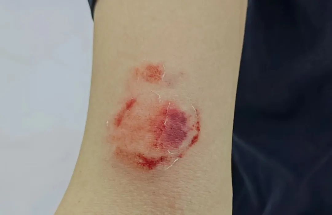 袭警!97年民警额头被钢筋砸伤,右手也被咬伤 袭警!97年民警额头被钢筋砸伤,右手也被咬伤