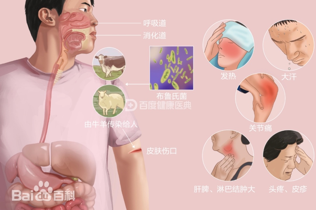 发烧一个月,七旬老两口被一杯羊奶“放倒”,原来是因为…… 发烧一个月,七旬老两口被一杯羊奶“放倒”,原来是因为……