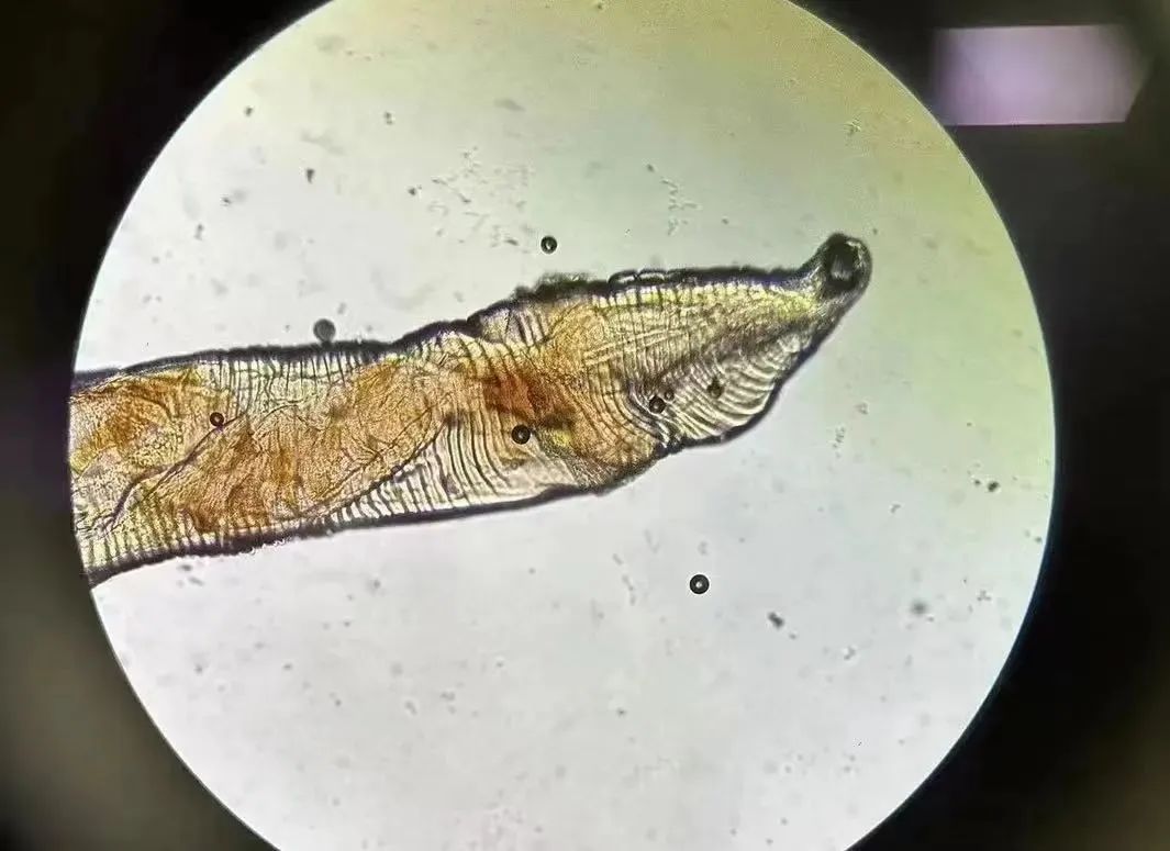 肠子肛门都有虫，还是活的！这些习惯容易“惹祸”