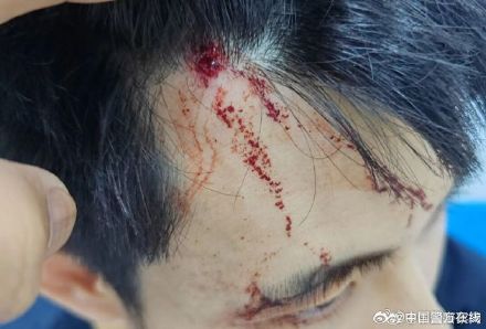 袭警!97年民警额头被钢筋砸伤,右手也被咬伤! 袭警!97年民警额头被钢筋砸伤,右手也被咬伤!