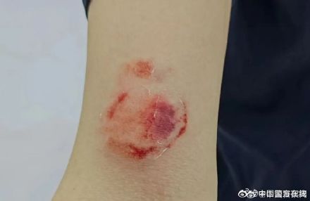 袭警!97年民警额头被钢筋砸伤,右手也被咬伤! 袭警!97年民警额头被钢筋砸伤,右手也被咬伤!