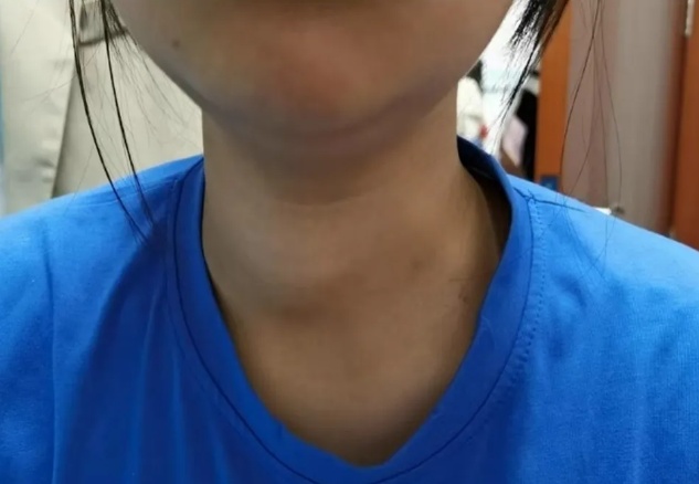 泉州13岁女孩确诊癌症!医生紧急提醒...... 泉州13岁女孩确诊癌症!医生紧急提醒......