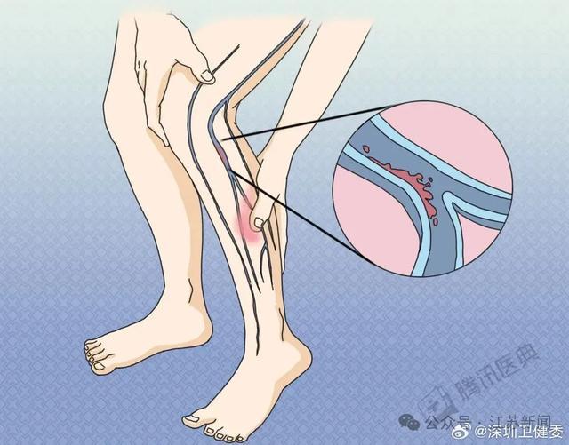 严重可致死！剧烈运动后千万别做这件事！