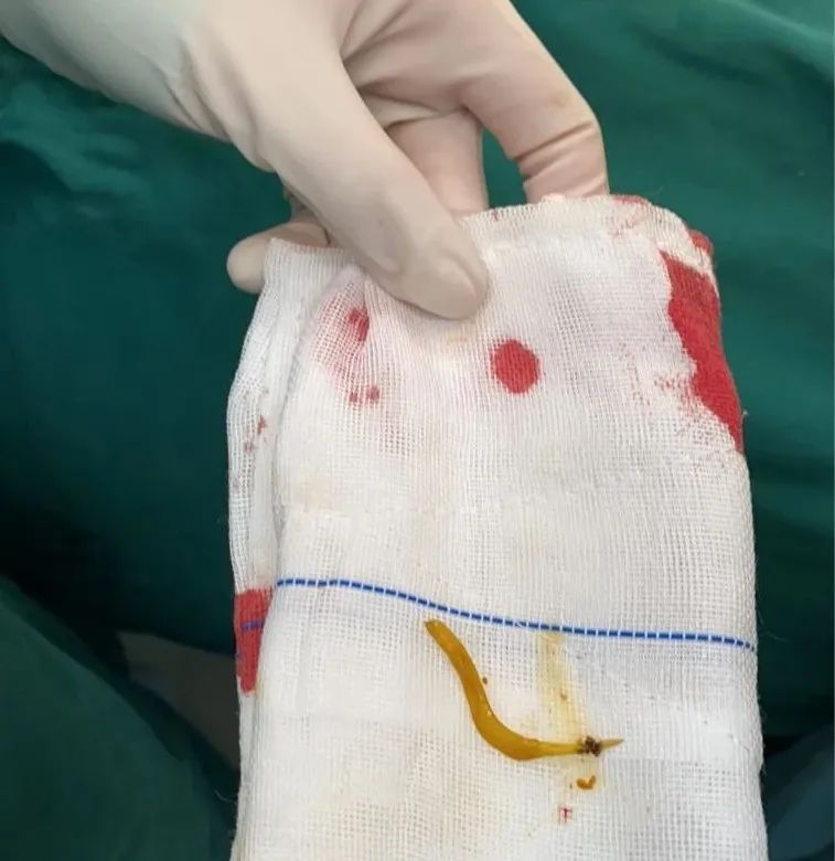 又是这根刺!我们问了医生,这个地方的刺,误吞的人最多! 又是这根刺!我们问了医生,这个地方的刺,误吞的人最多!